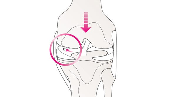 Meniscus tears