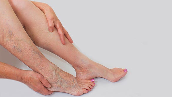 varicose veins