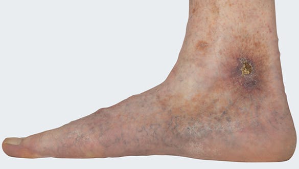 varicose vein disorder with florid ulcus cruris venosum