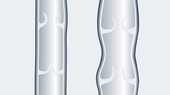 Thread vein and varicose veins